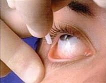 L'anestesia topica consiste nell’instillazione di gocce di anestetici locali sulla cornea