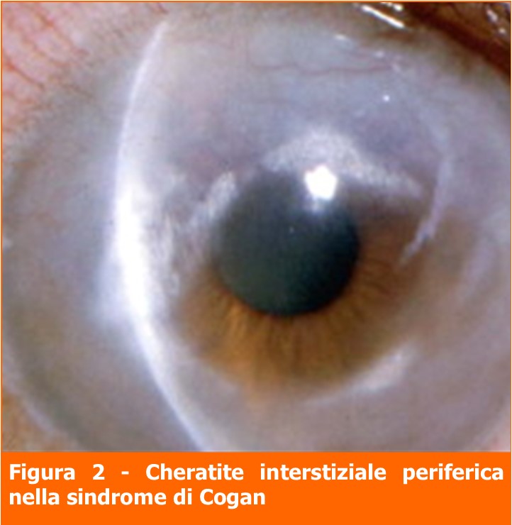 Cheratite interstiziale periferica-professione oculista-MEI