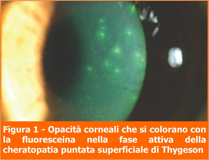 Opacità corneali-cheratopatia thygeson-professione oculista-MEI