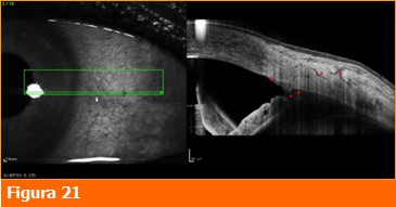 foto21-oct-glaucoma-professioneoculista-ecm