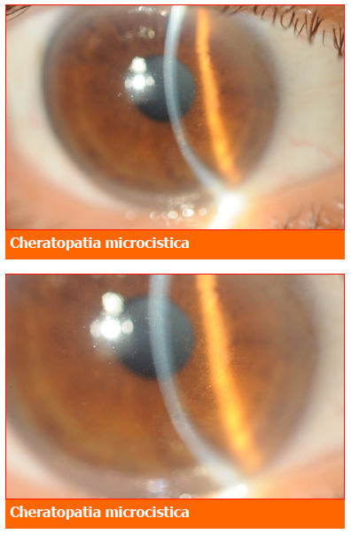 cheratopatia microcistica-professione oculista-medical evidence-mieloma