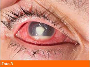 Segni clinici-endoftalmite-3-professione oculista-ecm-medical evidence
