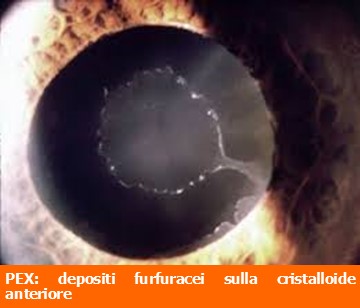 Sindrome da pseudoesfoliazione-PEX-depositi furfuracei-ecm-professione oculista