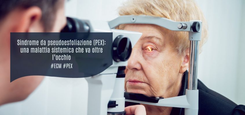 Sindrome da pseudoesfoliazione (PEX): una malattia sistemica che va oltre l’occhio