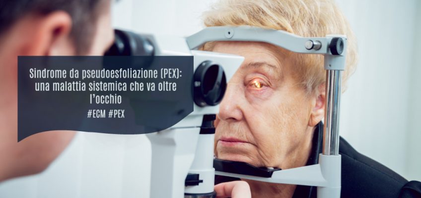 Sindrome-pseudoesfoliazione-PEX-malattia sistemica-occhio-oculisti-ortottisti-ecm-professione oculista-medical evidence